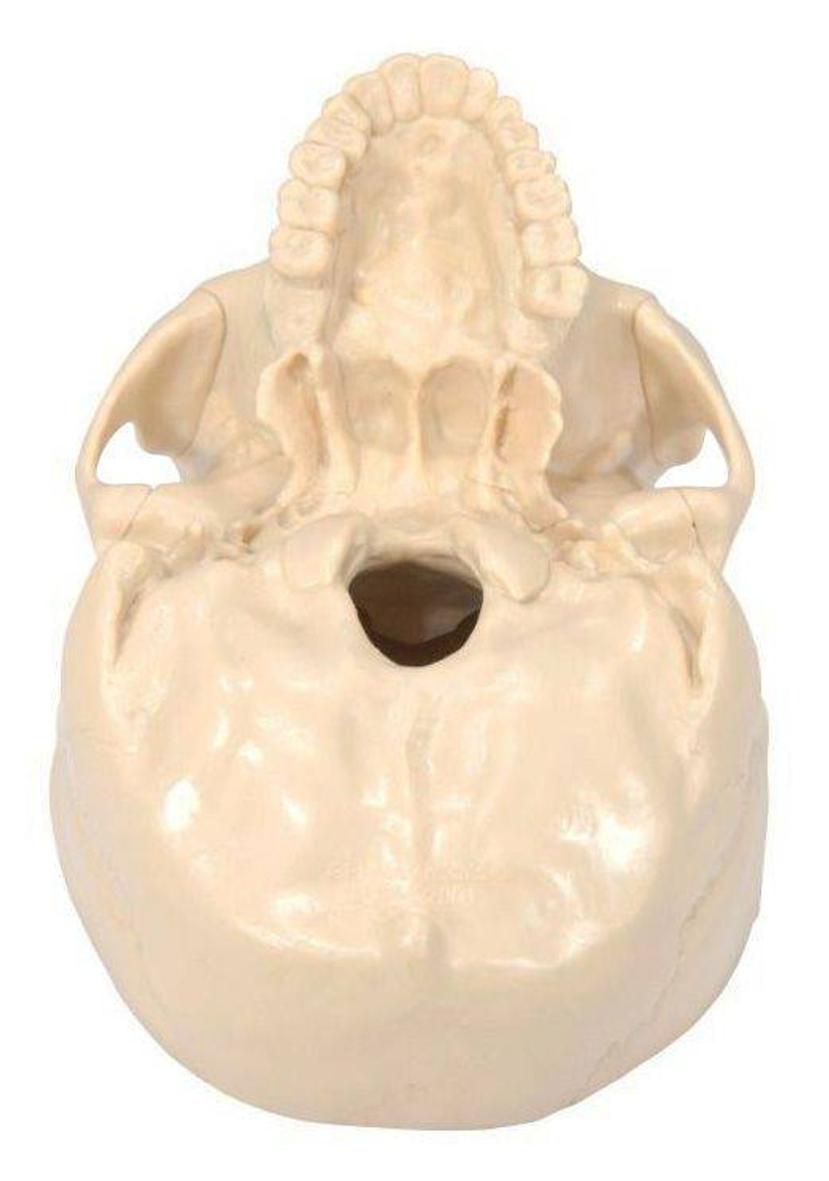 Diseased Brain In Skull Anatomy Model
