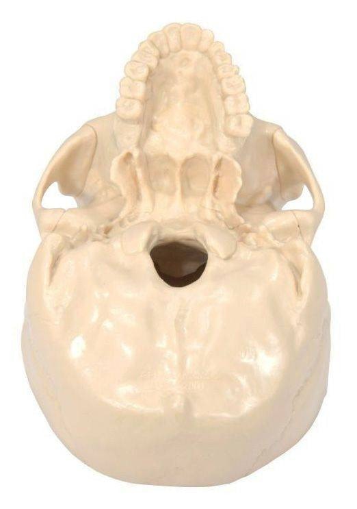 Diseased Brain In Skull Anatomy Model