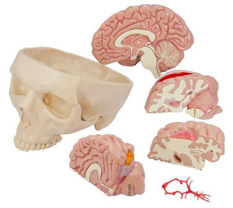 Diseased Brain In Skull Anatomy Model