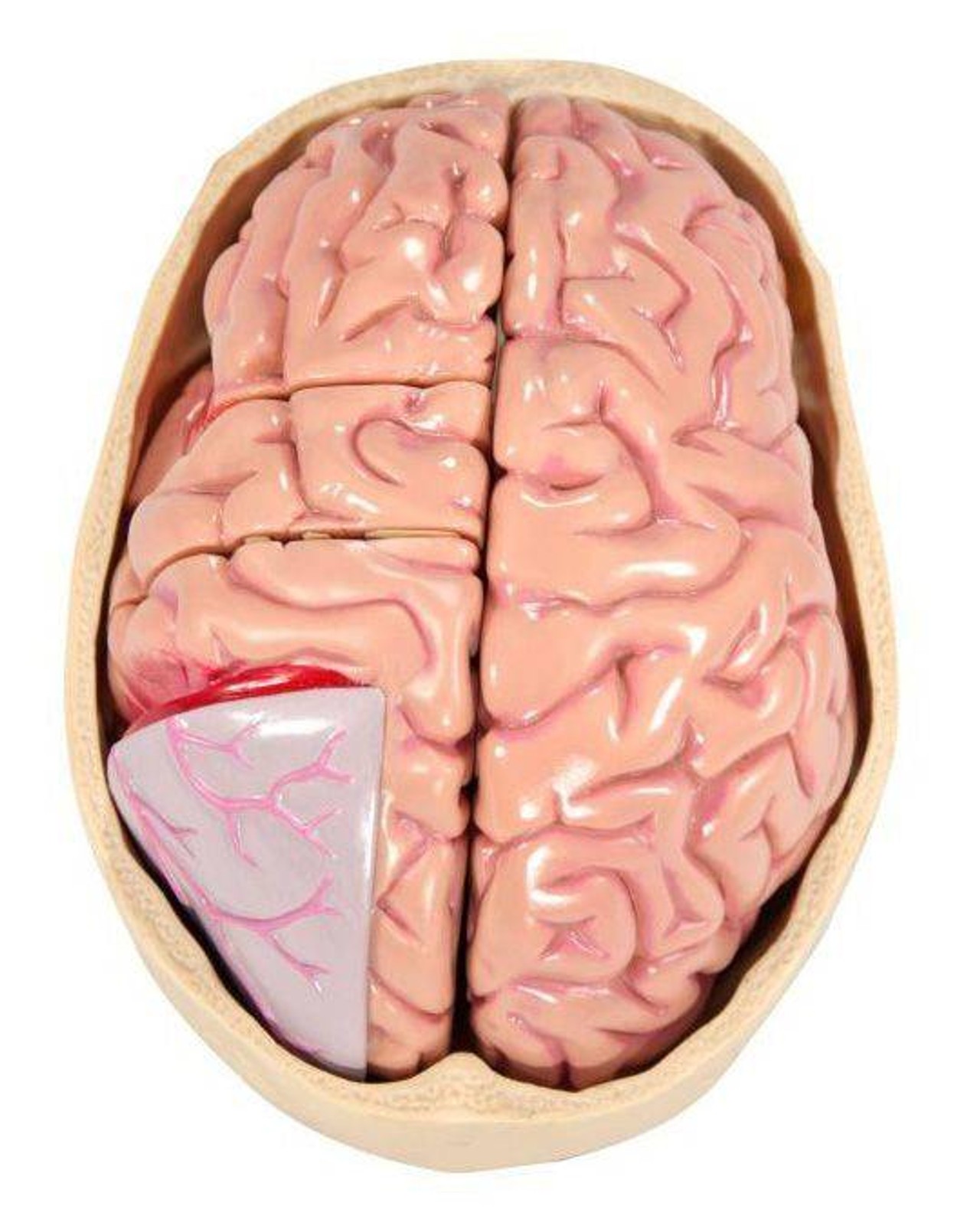 Diseased Brain In Skull Anatomy Model