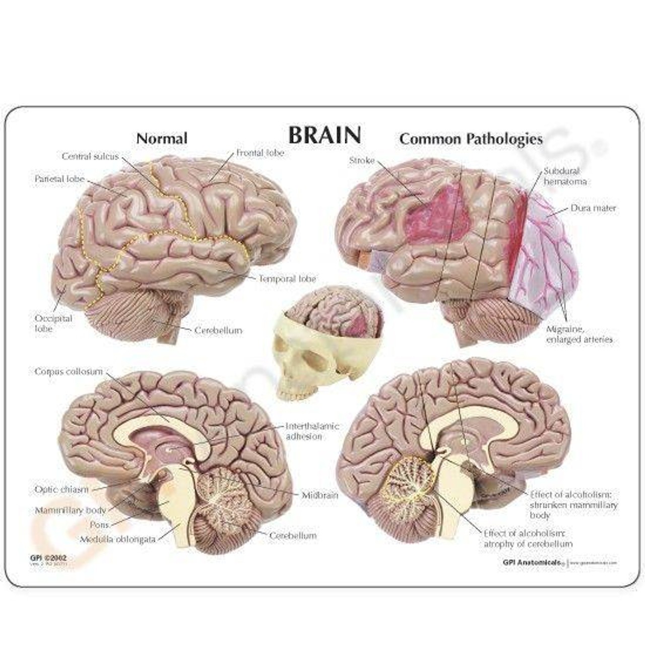 Diseased Brain In Skull Anatomy Model