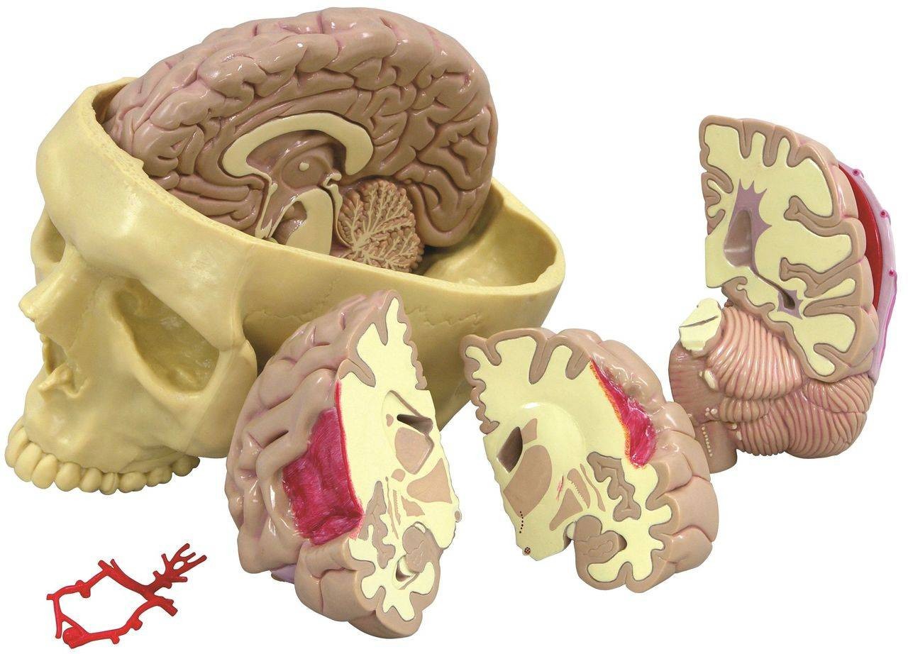 Diseased Brain In Skull Anatomy Model