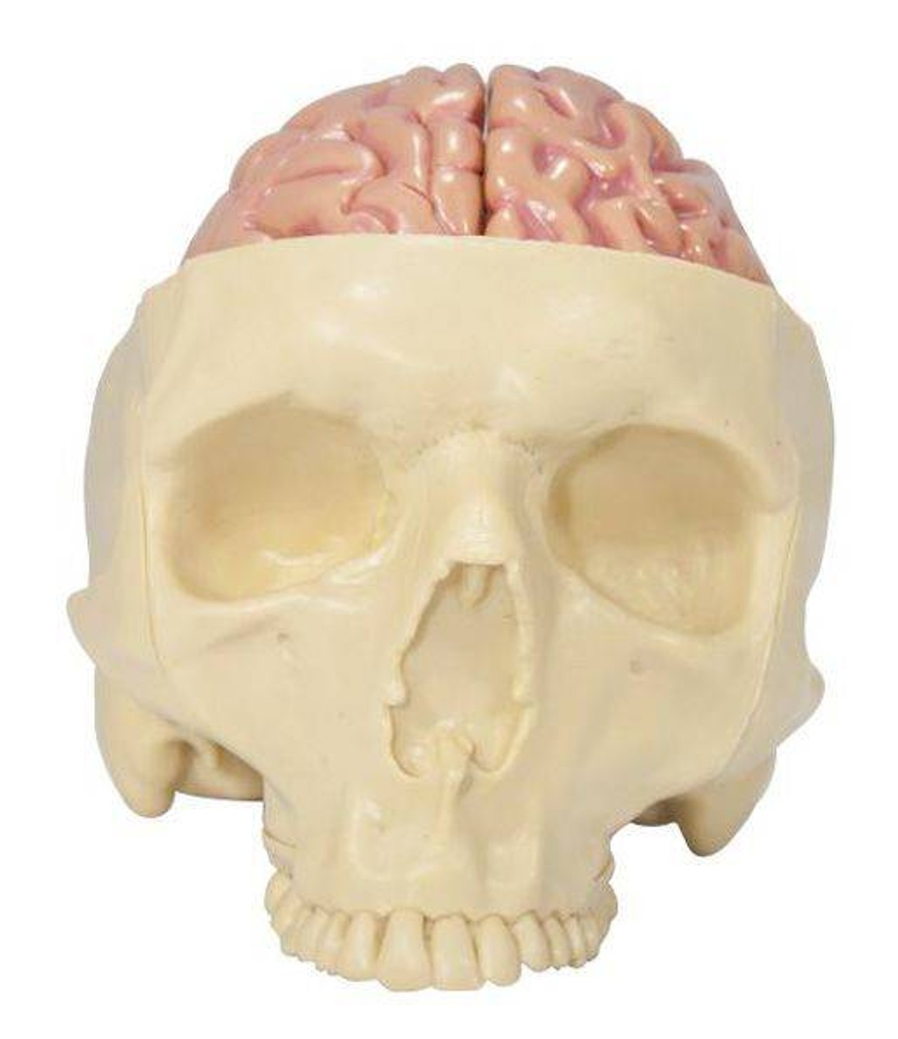 Diseased Brain In Skull Anatomy Model