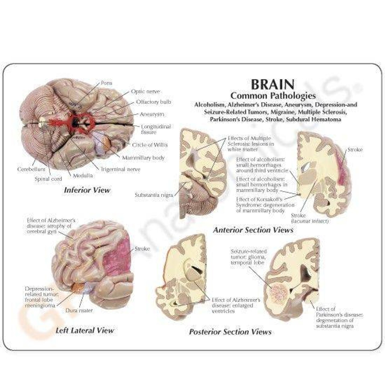 Diseased Brain In Skull Anatomy Model