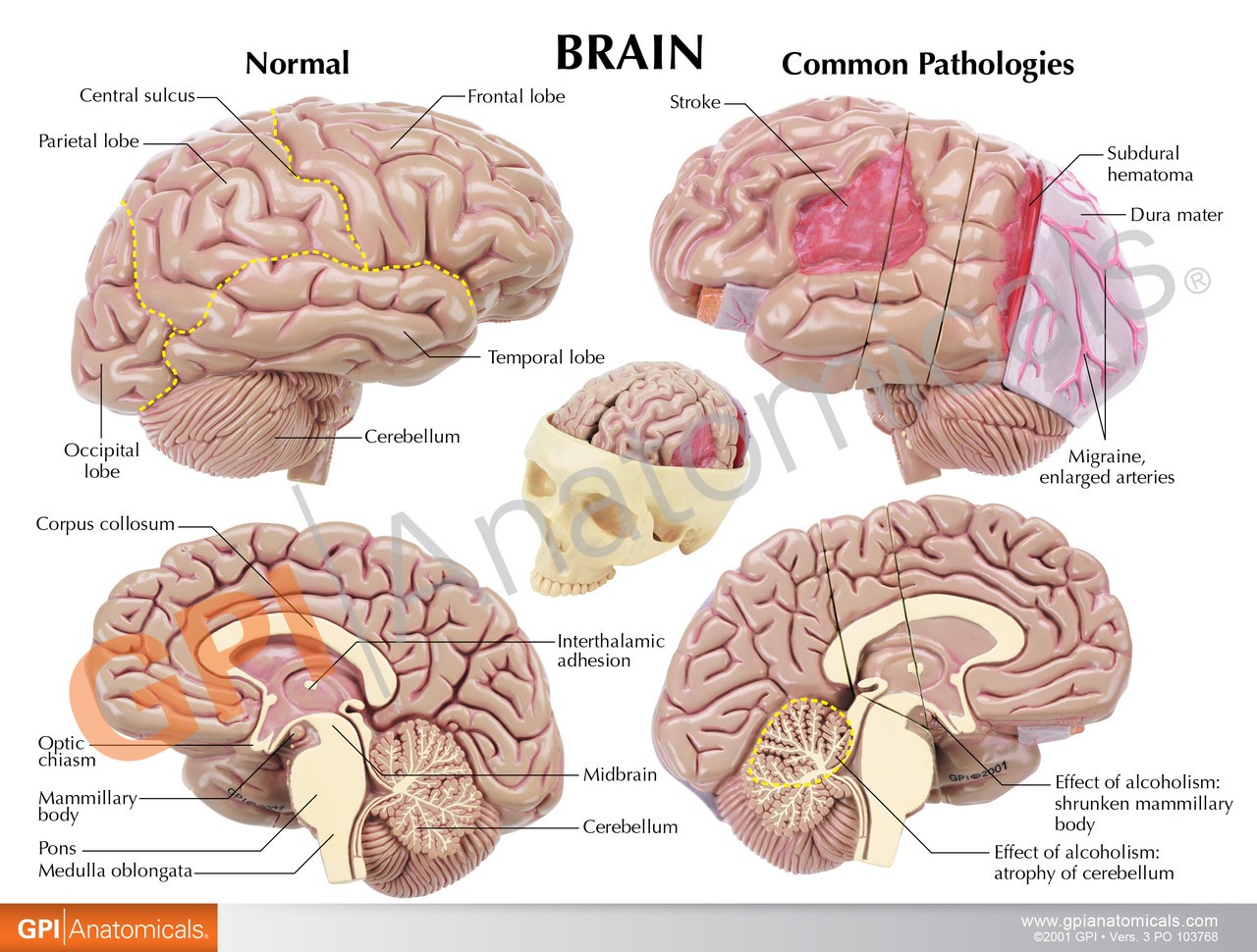 Diseased Brain In Skull Anatomy Model