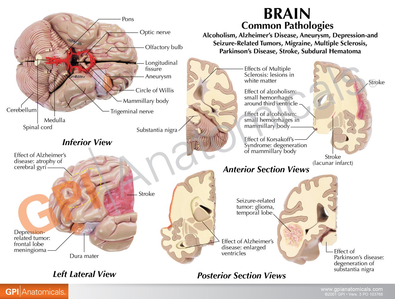 Diseased Brain In Skull Anatomy Model