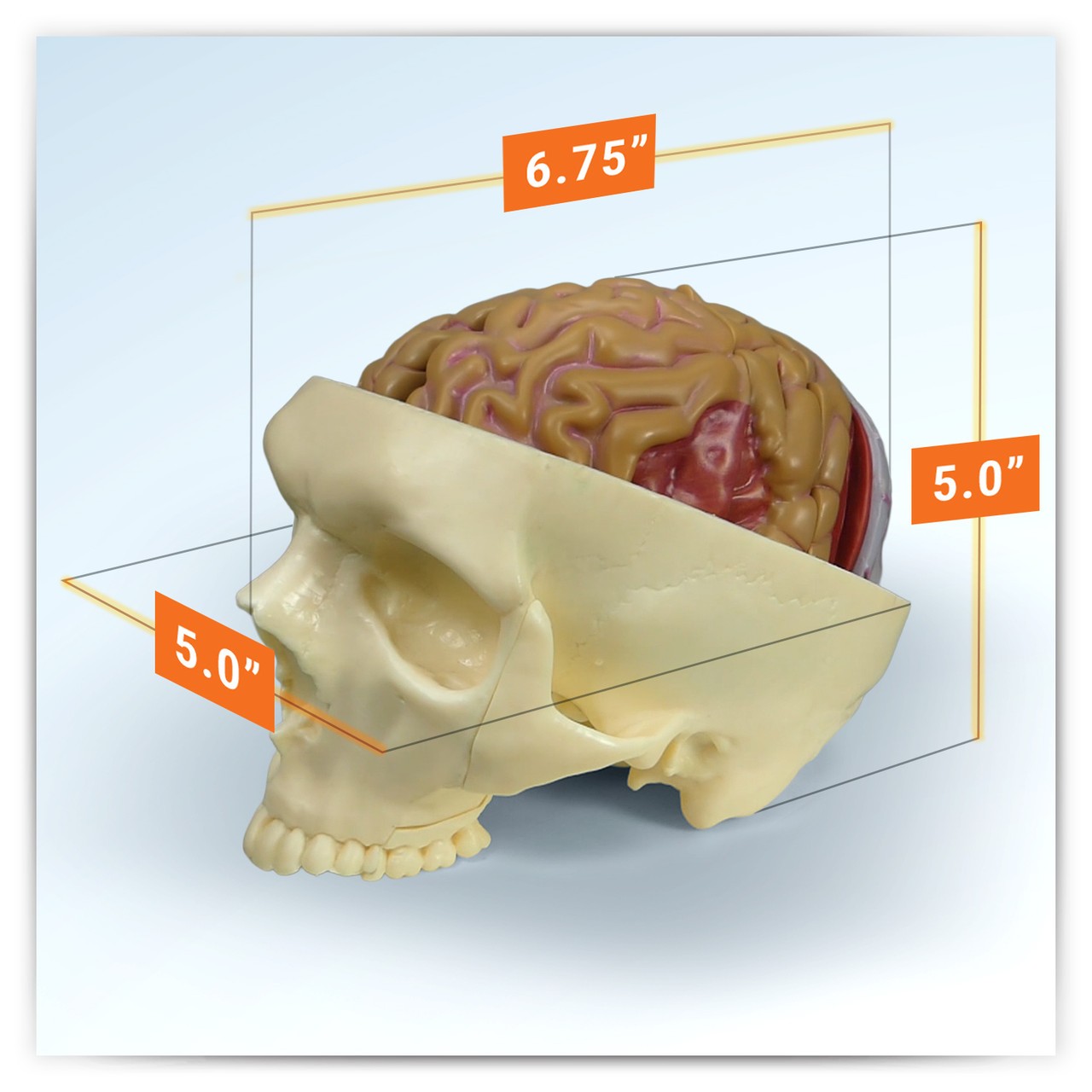 Diseased Brain In Skull Anatomy Model