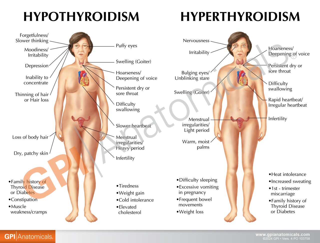 Thyroid Disease Anatomy Model