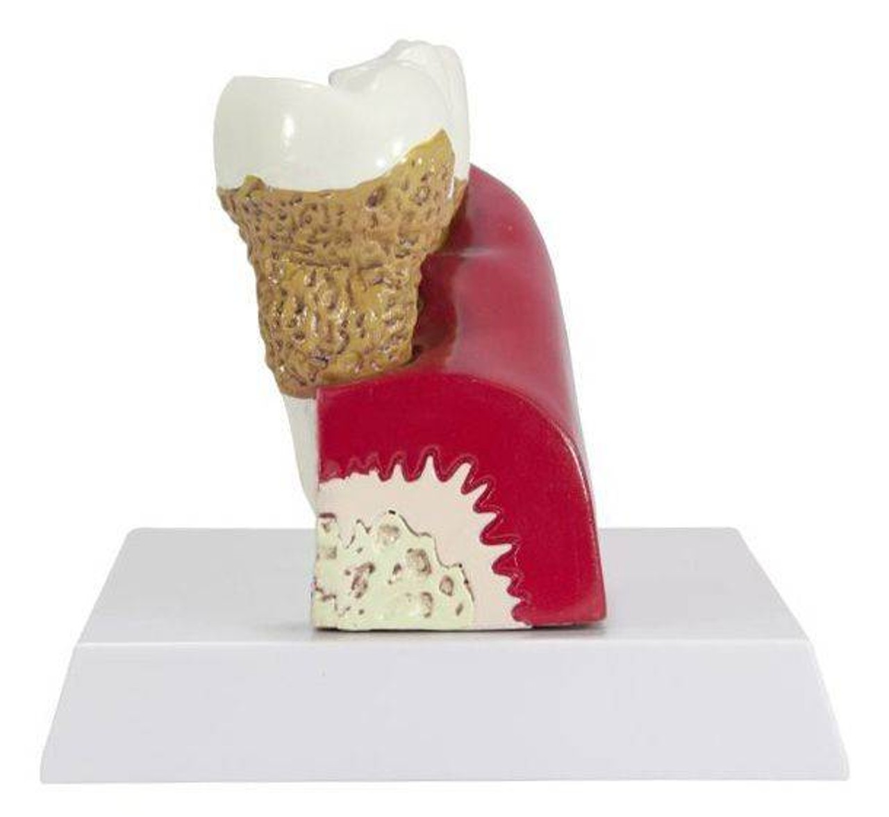 Diseased Teeth and Gums Anatomy Model