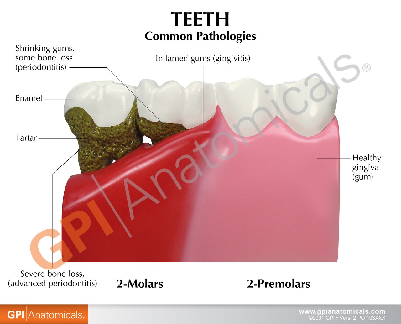 Diseased Teeth and Gums Anatomy Model