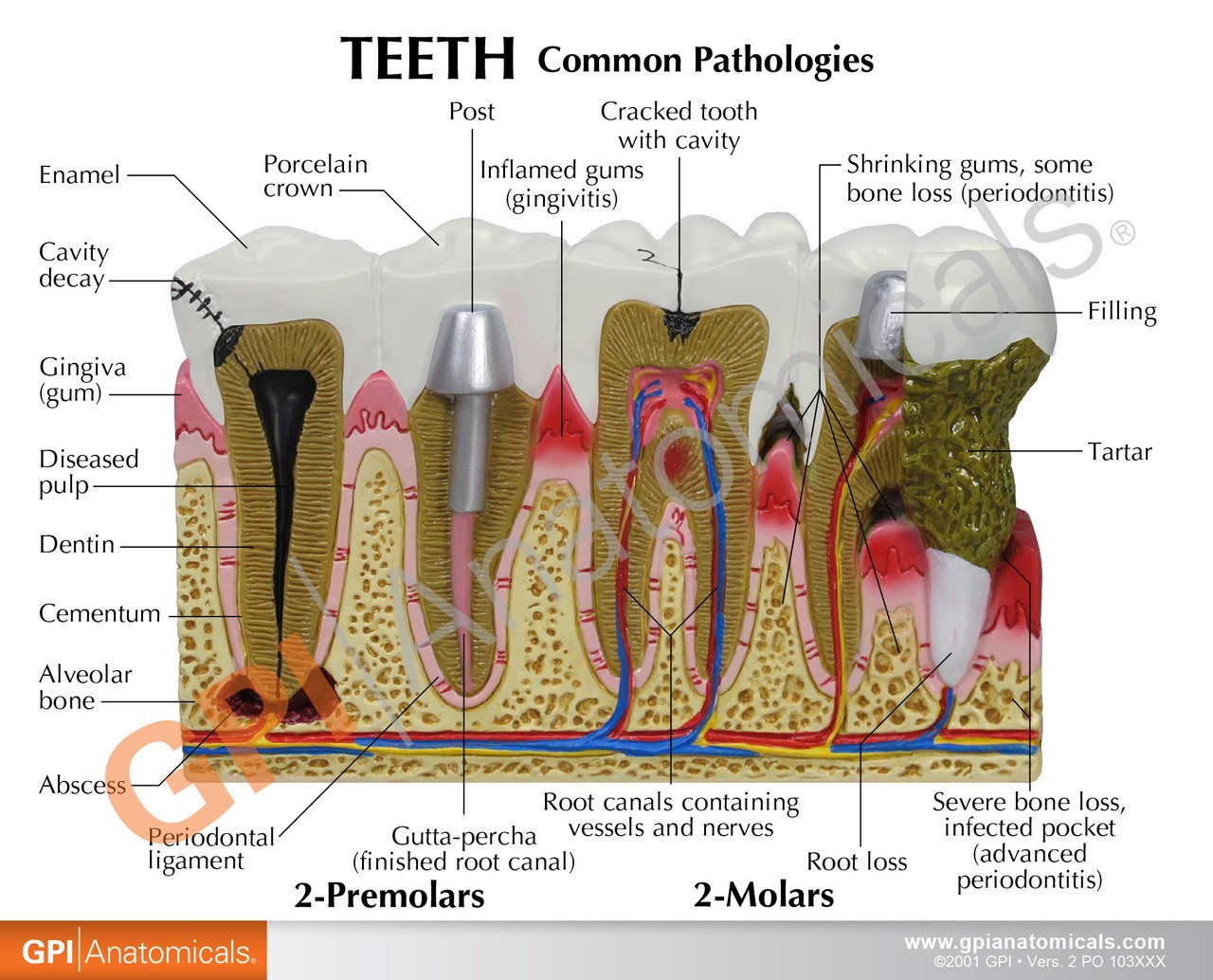 Diseased Teeth and Gums Anatomy Model