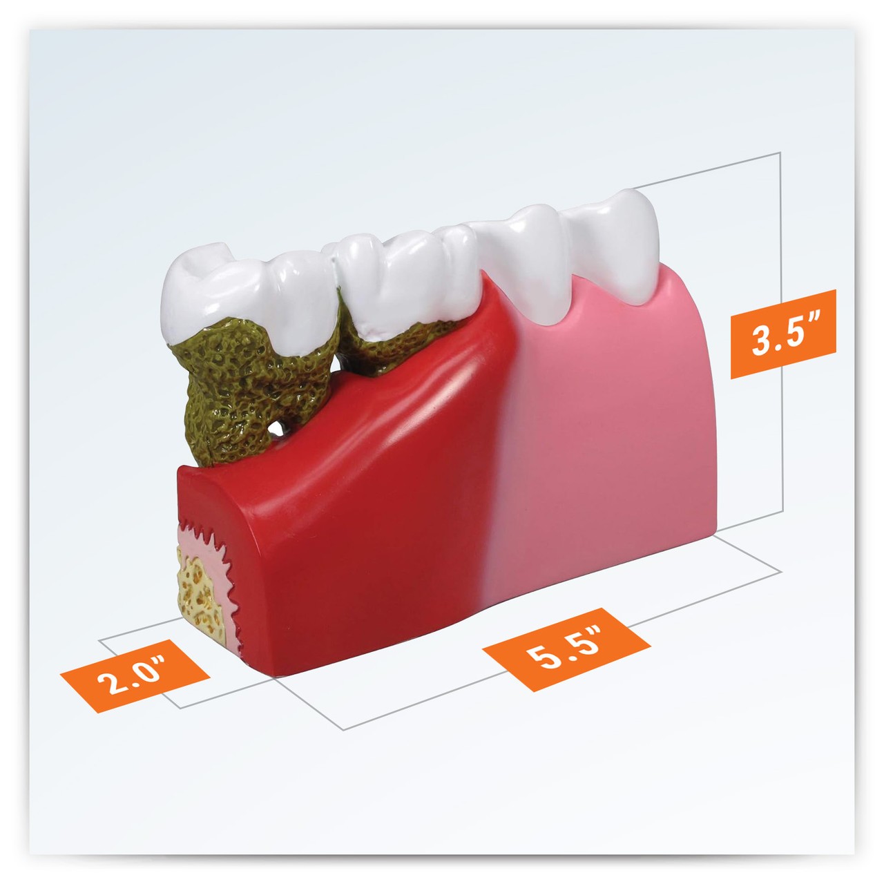Diseased Teeth and Gums Anatomy Model