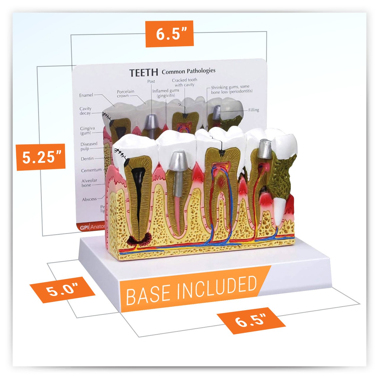 Diseased Teeth and Gums Anatomy Model