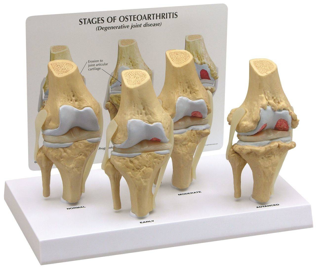 4 Stage Osteoarthritis Knee Set Anatomy Model