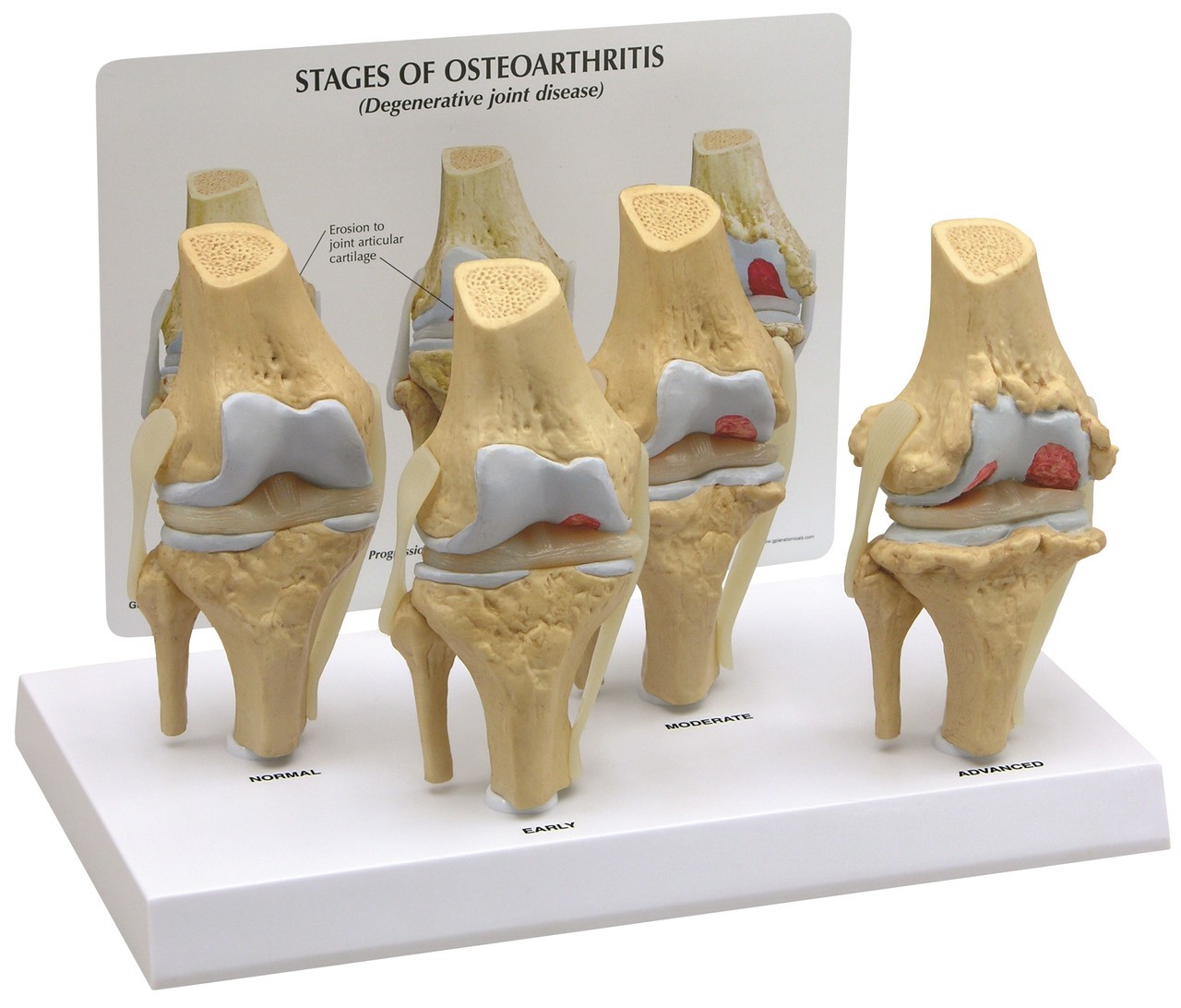 4 Stage Osteoarthritis Knee Set Anatomy Model