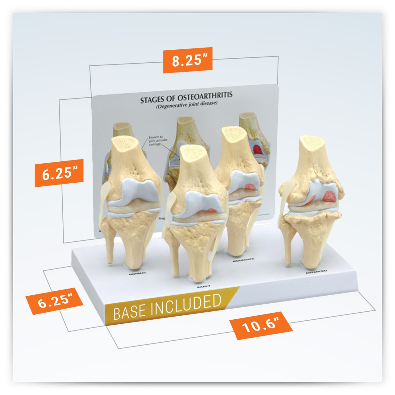 4 Stage Osteoarthritis Knee Set Anatomy Model