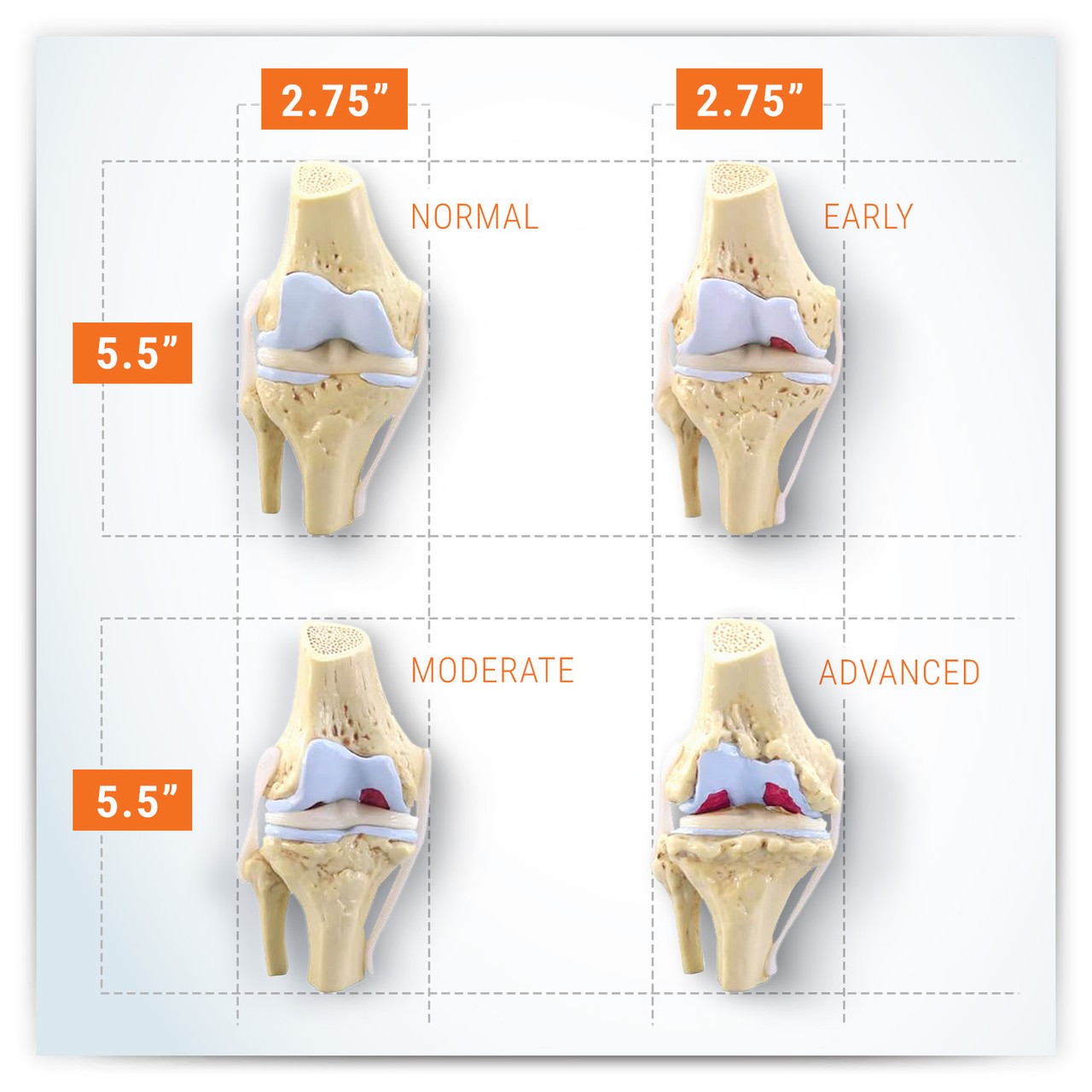 4 Stage Osteoarthritis Knee Set Anatomy Model