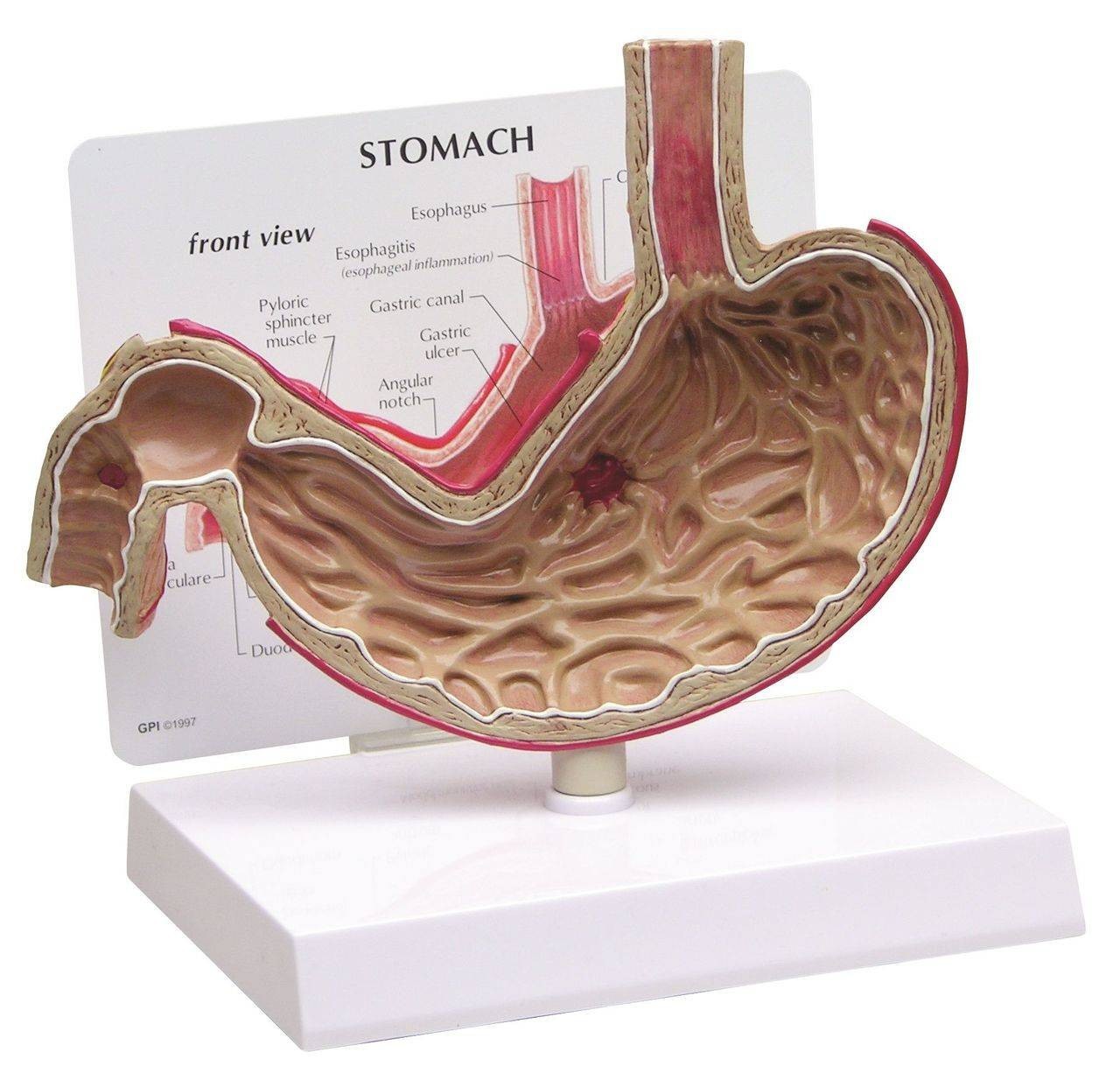 Stomach With Ulcers Anatomy Model