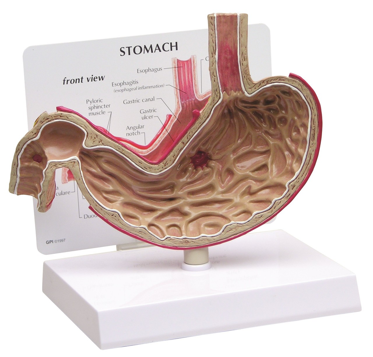 Stomach With Ulcers Anatomy Model