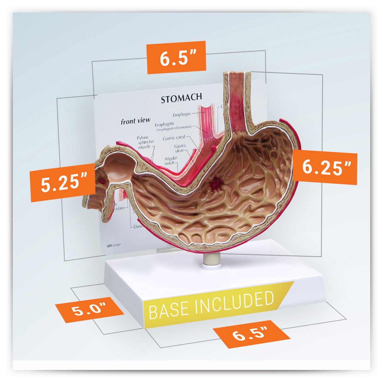 Stomach With Ulcers Anatomy Model