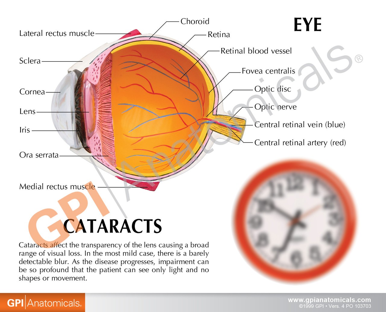 Cataract Eye Anatomy Model