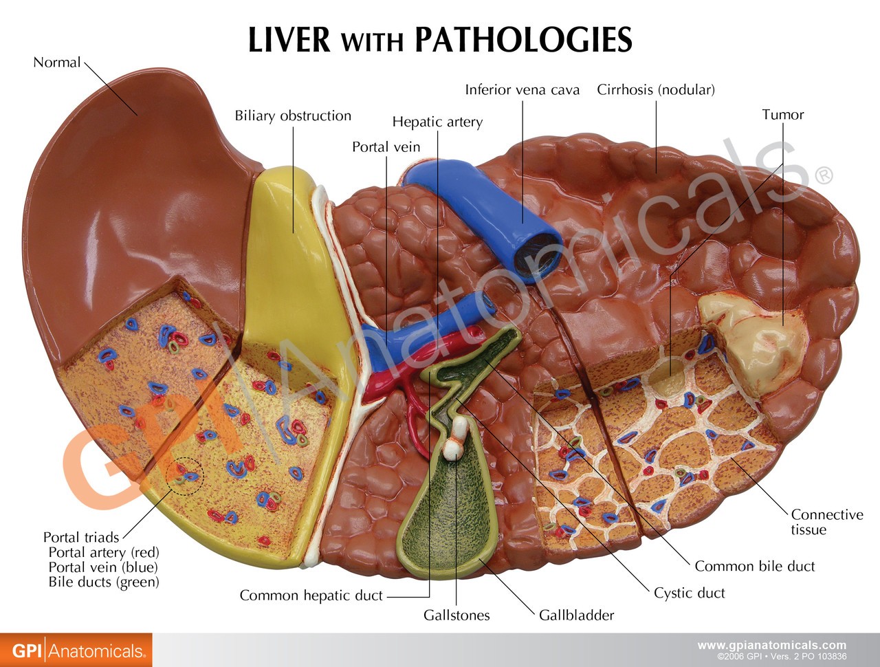 Diseased Liver Anatomy Model