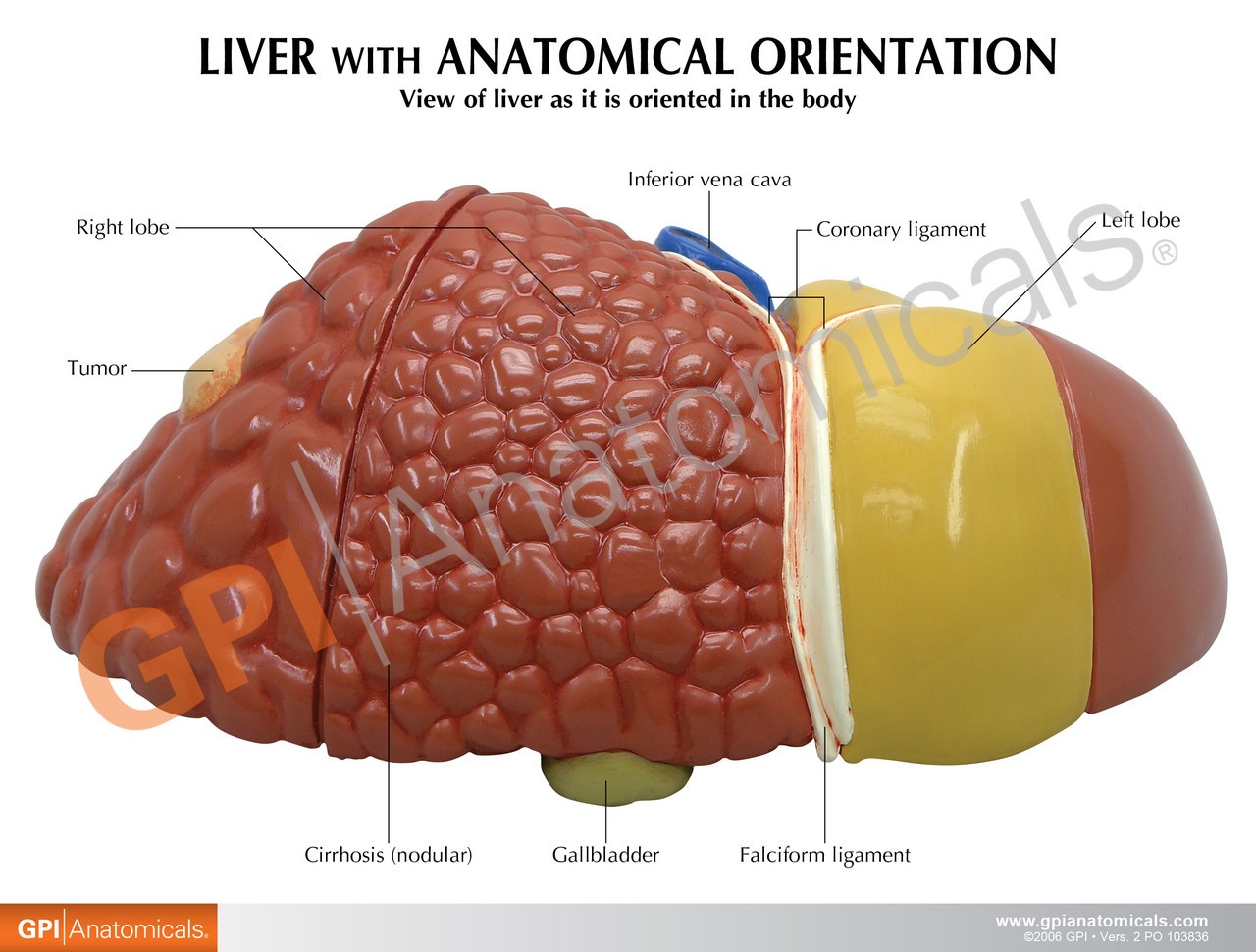 Diseased Liver Anatomy Model