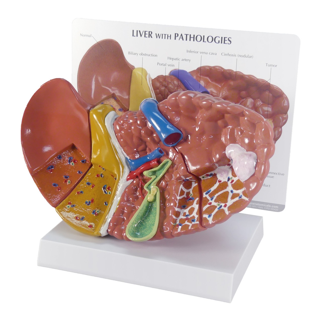 Diseased Liver Anatomy Model