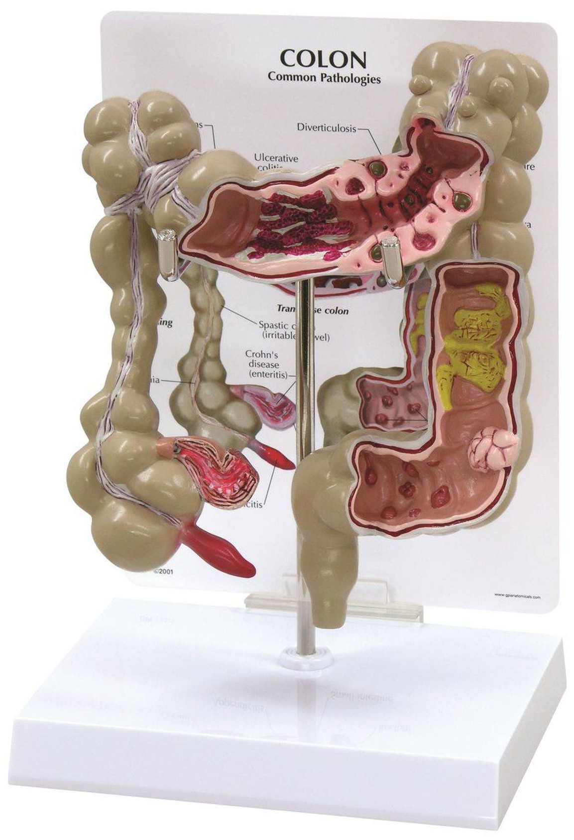 Colon Anatomy Model With Pathologies