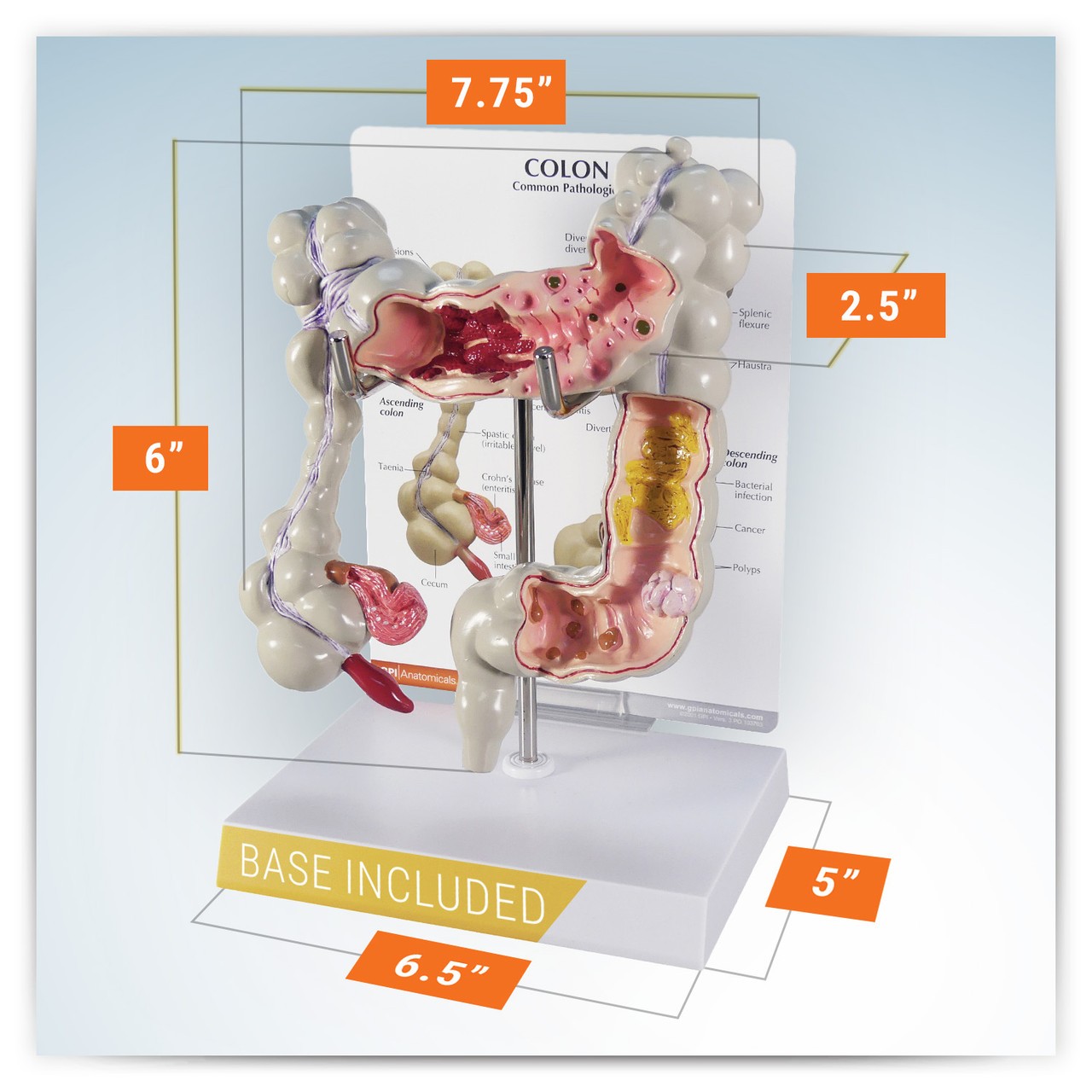 Colon Anatomy Model With Pathologies
