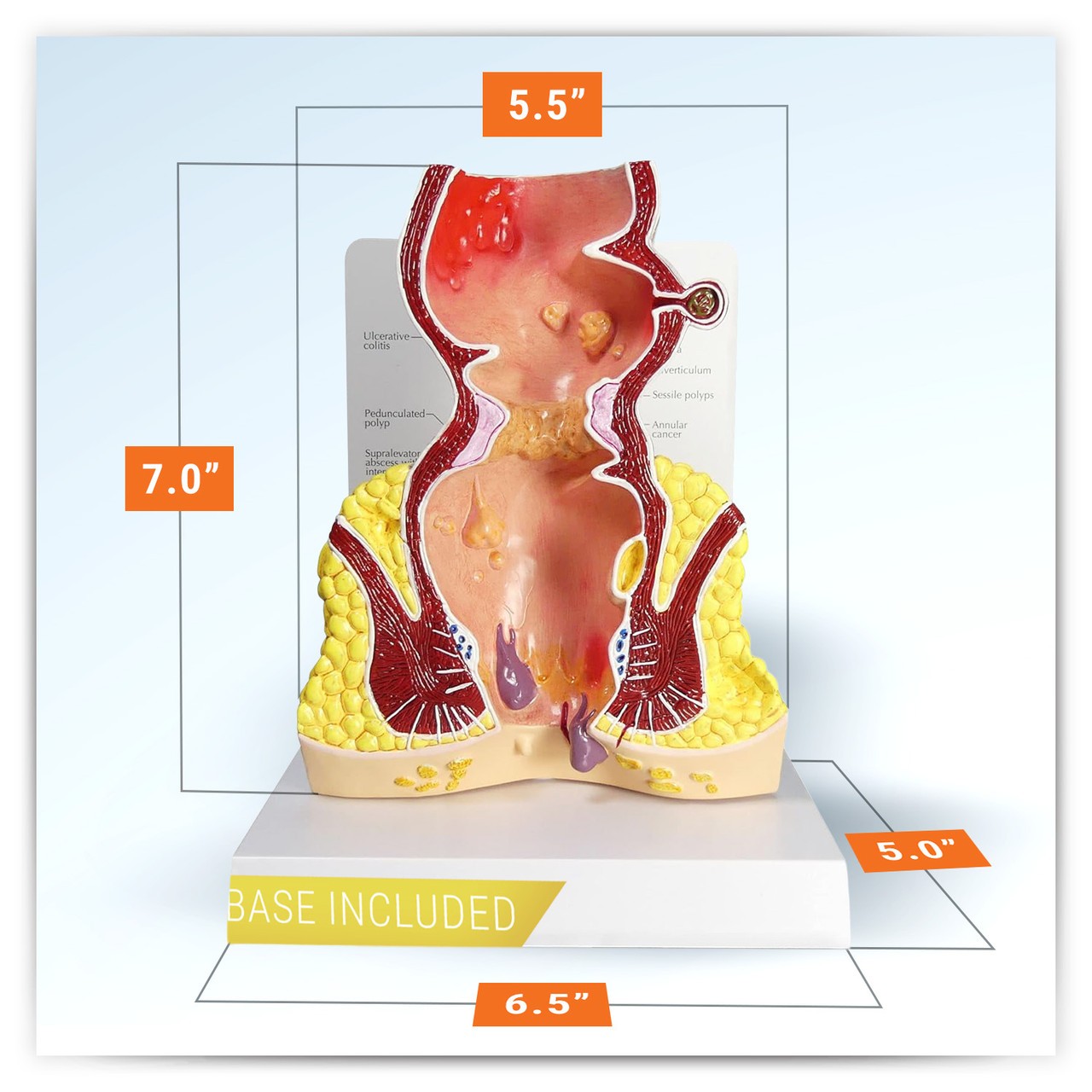 Rectum Anatomy Model With Pathologies