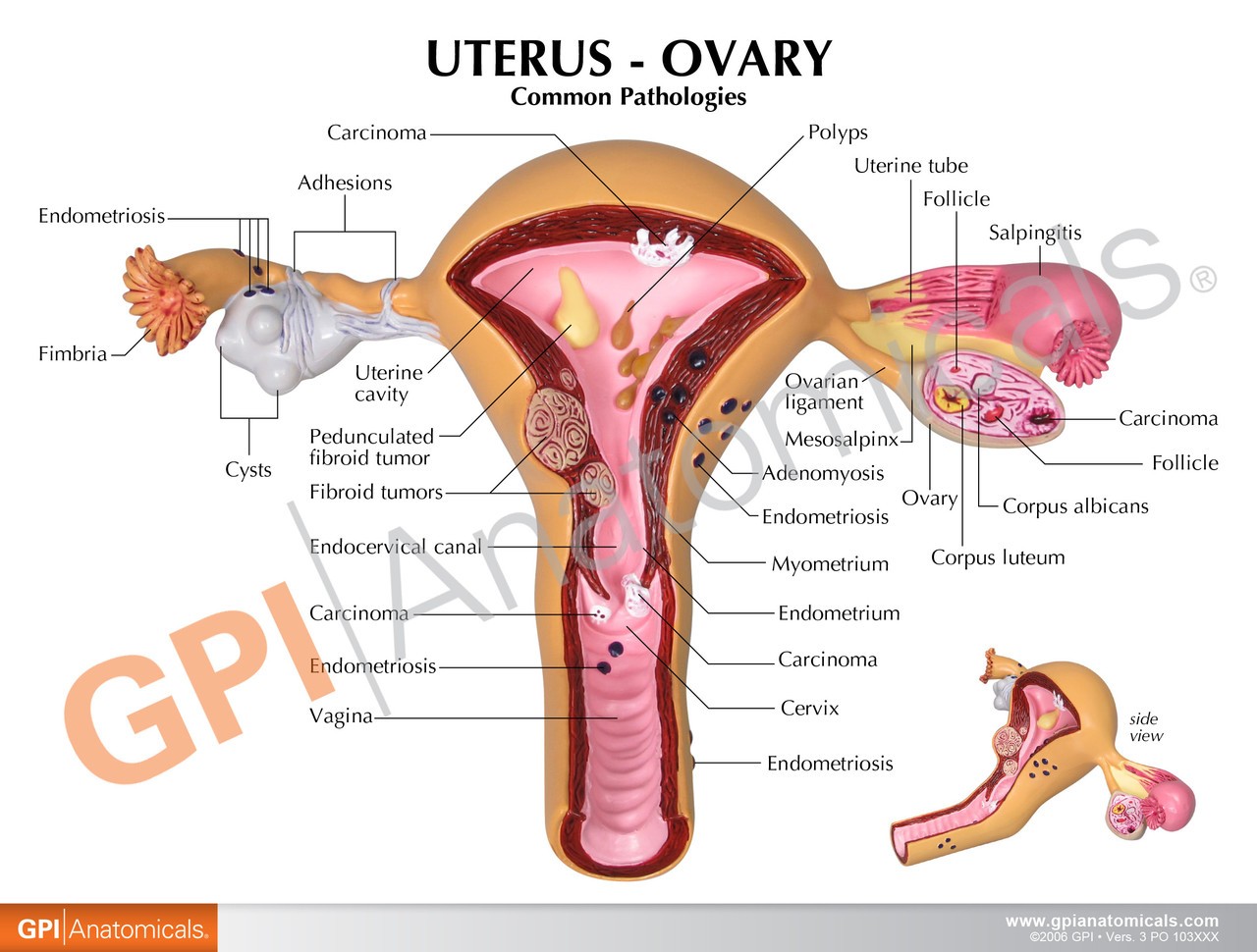 Uterus and Ovary Anatomy Model With Pathologies
