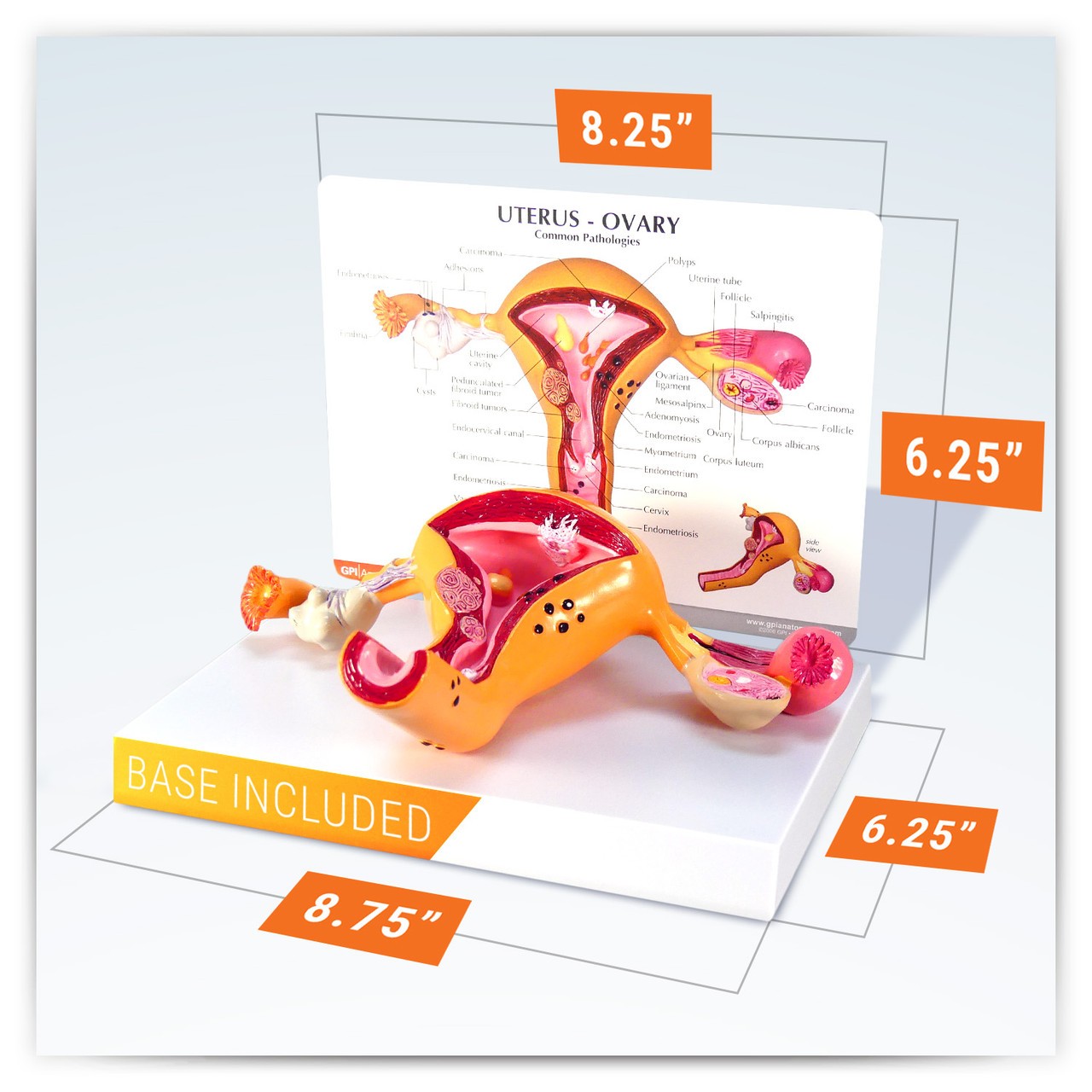 Uterus and Ovary Anatomy Model With Pathologies
