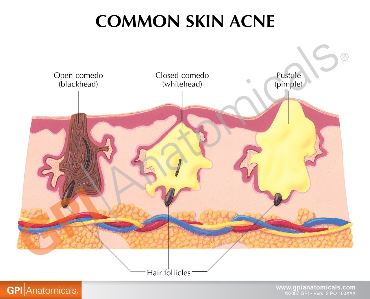 Acne Skin Anatomy Model