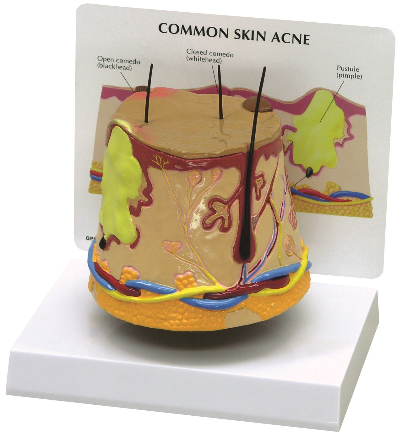 Acne Skin Anatomy Model