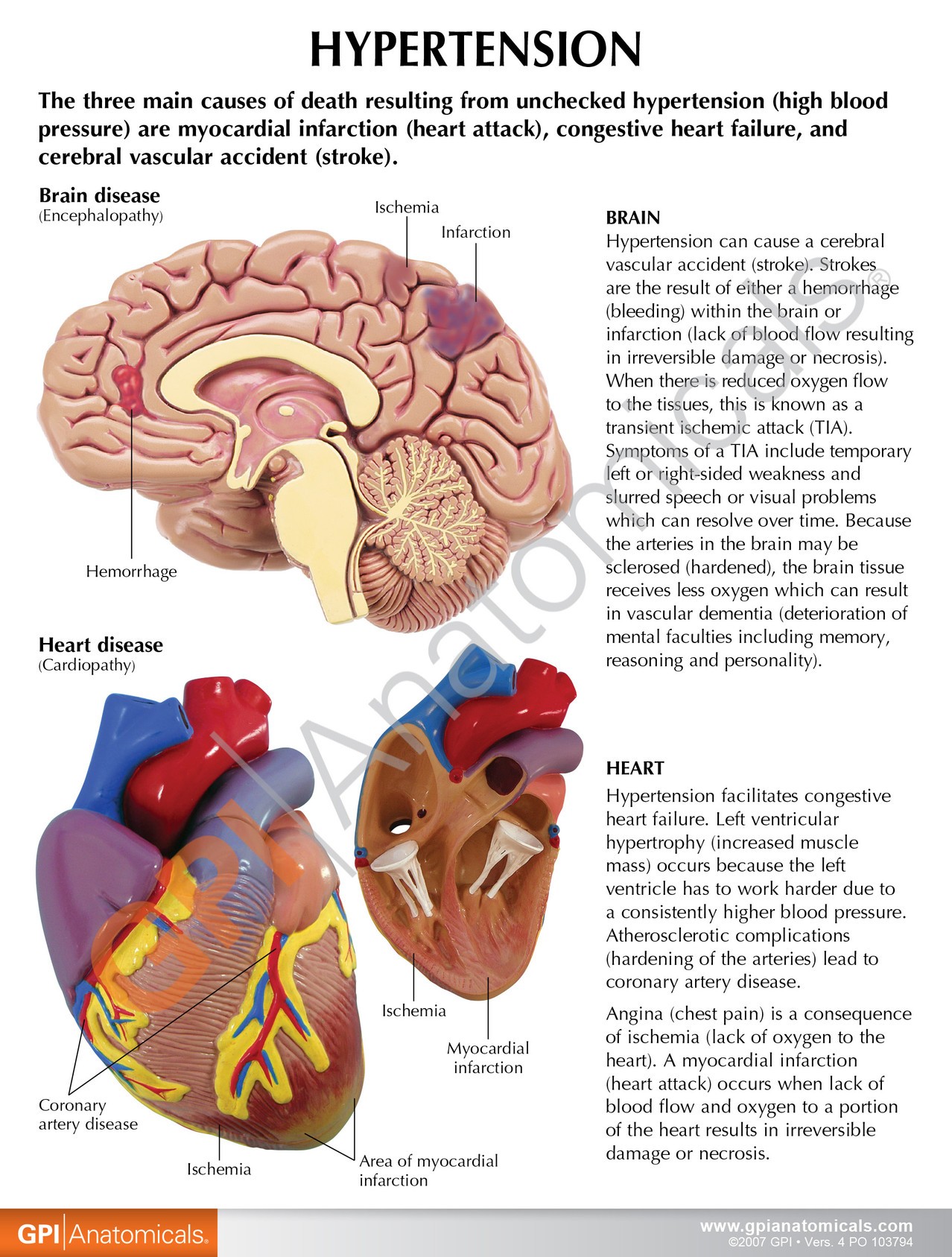 Hypertension Anatomy Model Set