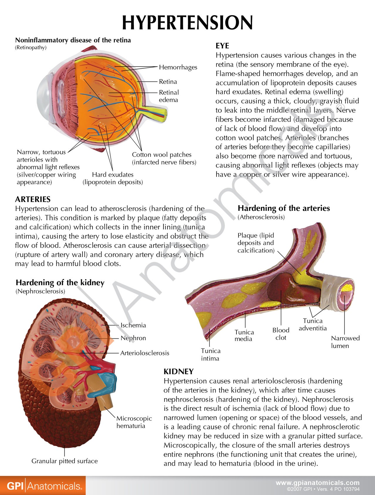 Hypertension Anatomy Model Set