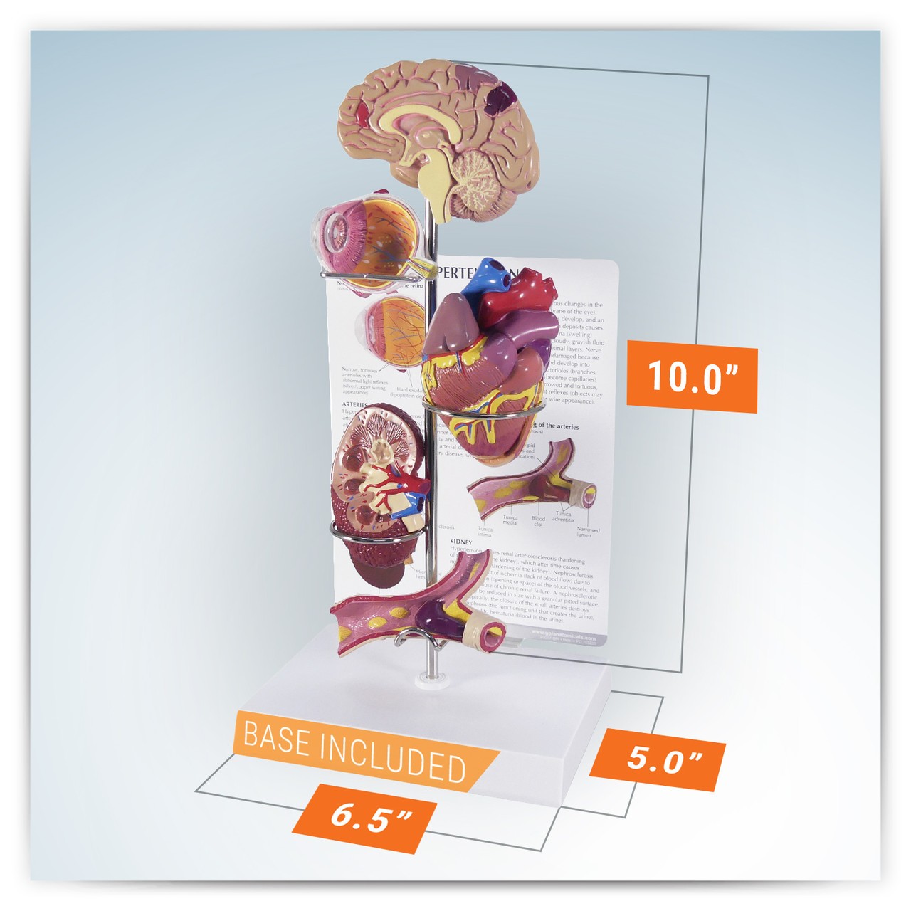 Hypertension Anatomy Model Set