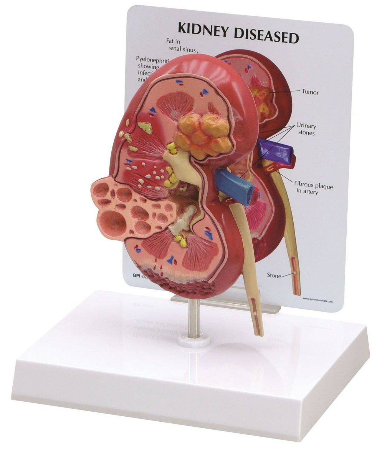Diseased Kidney Anatomy Model
