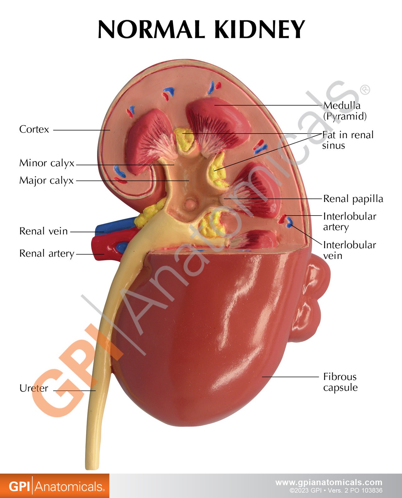 Diseased Kidney Anatomy Model