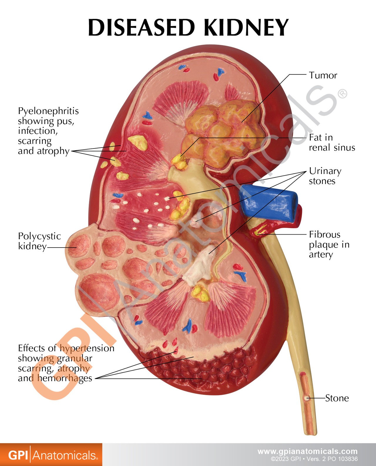 Diseased Kidney Anatomy Model