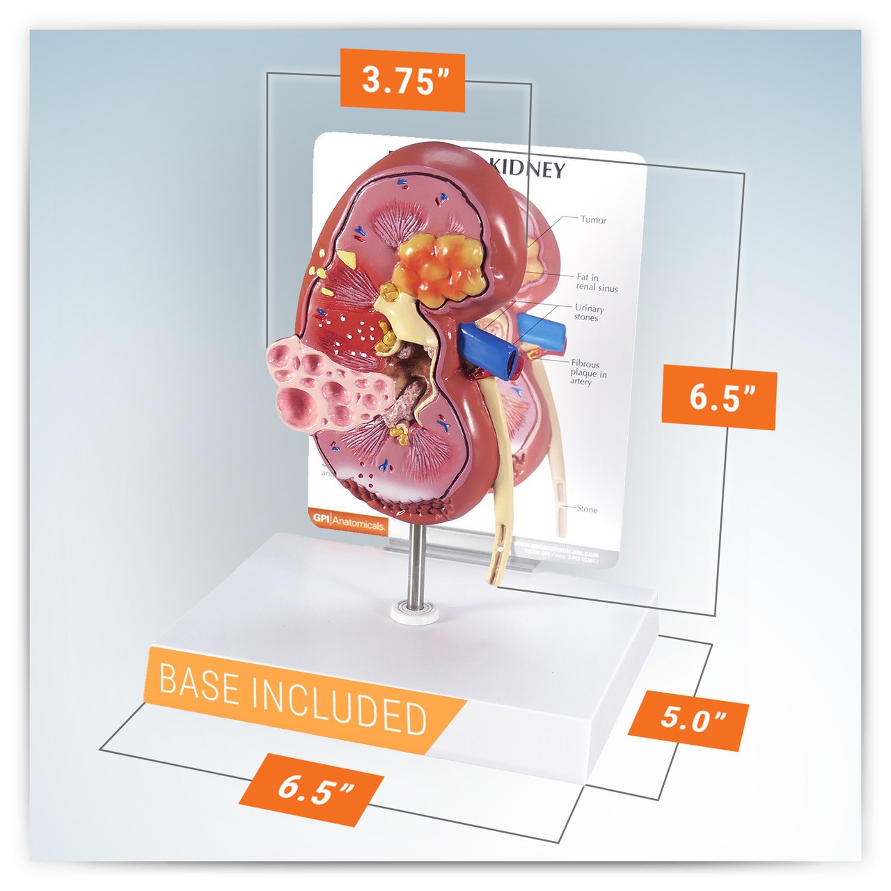 Diseased Kidney Anatomy Model