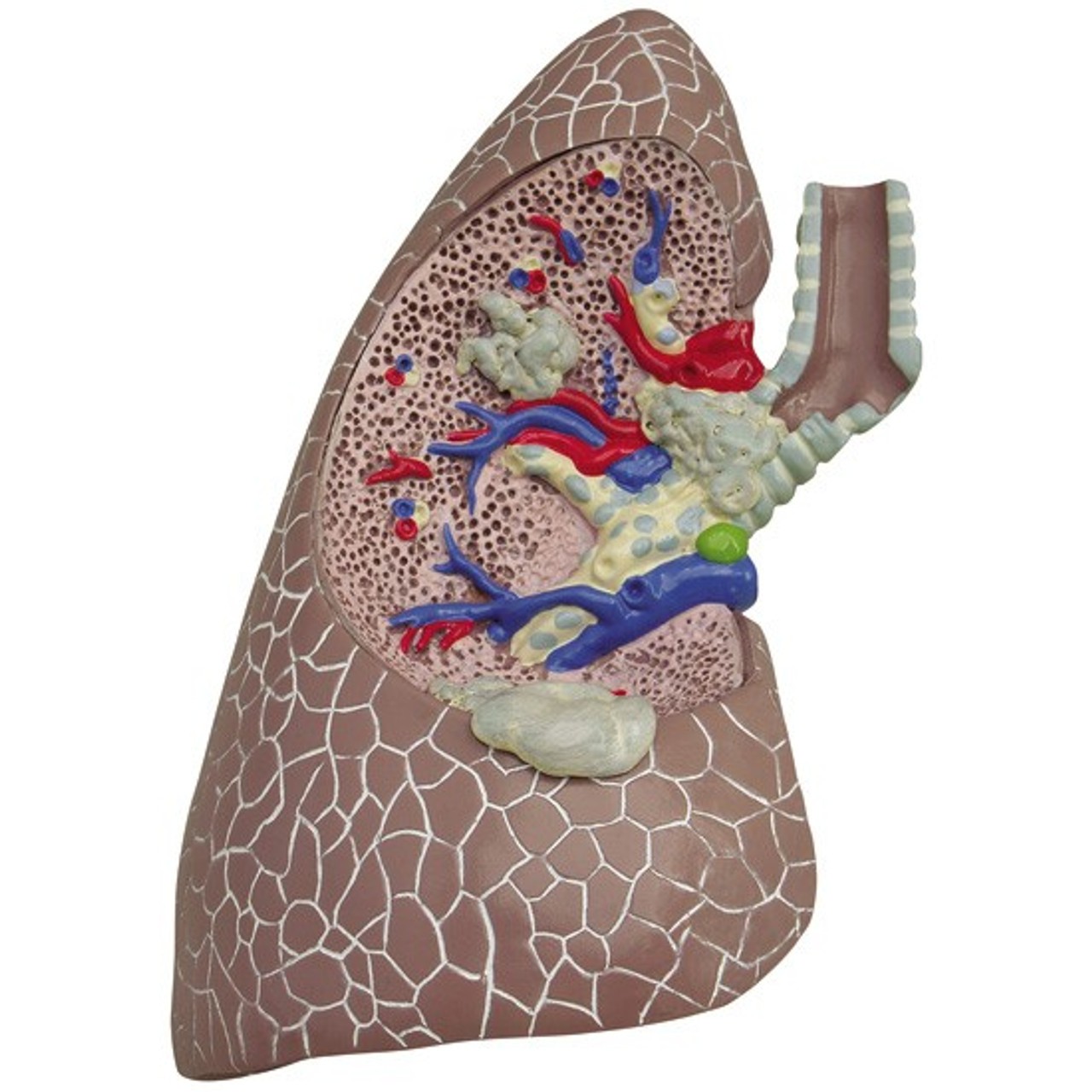 Diseased Lung with cancer and pathologies