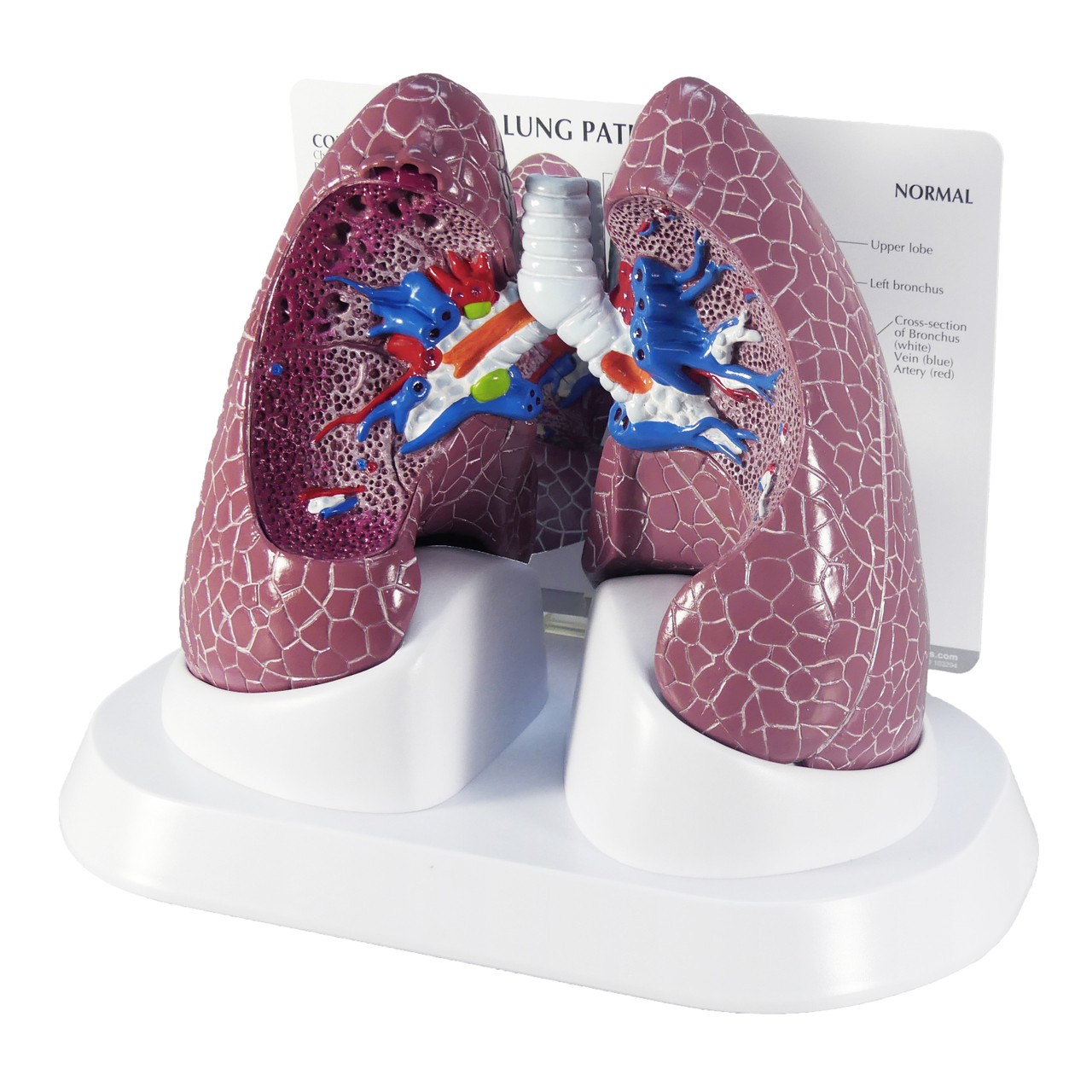 Diseased Lung Anatomy Model