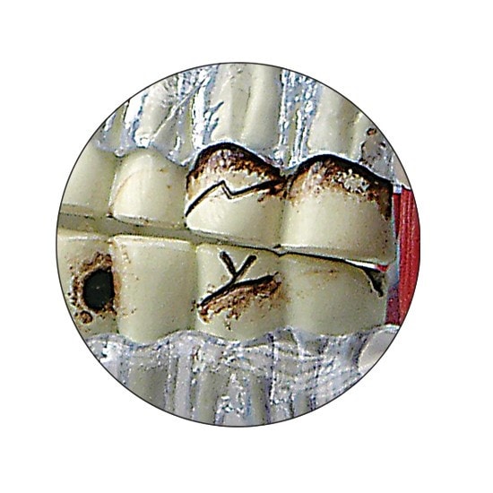 TMJ Clear Skull Anatomy Model