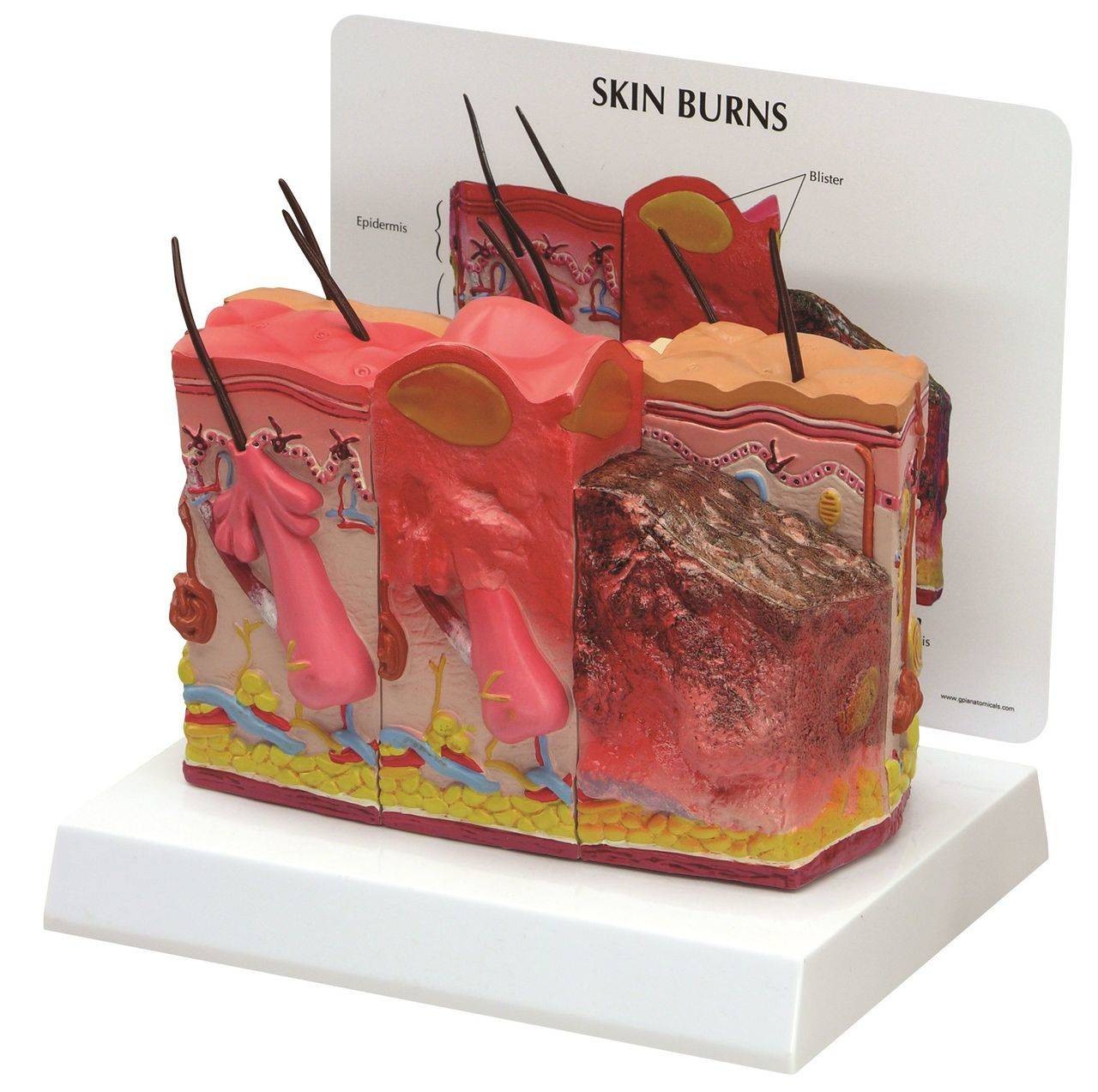 Skin Burn and Normal Skin Anatomy Model