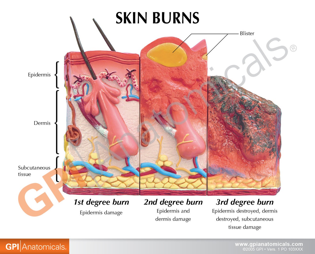 Skin Burn and Normal Skin Anatomy Model