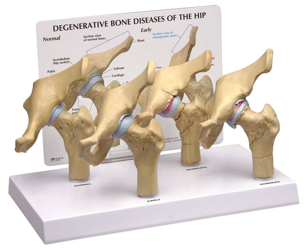 4-Stage Arthritic Hip Anatomy Model