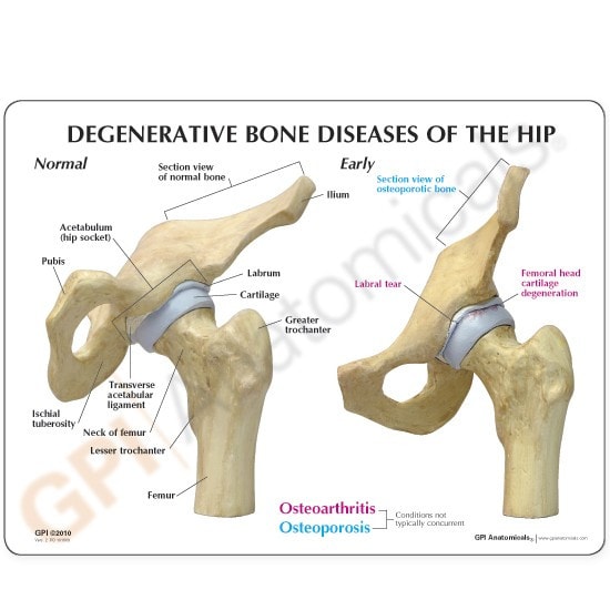 4-Stage Arthritic Hip Anatomy Model