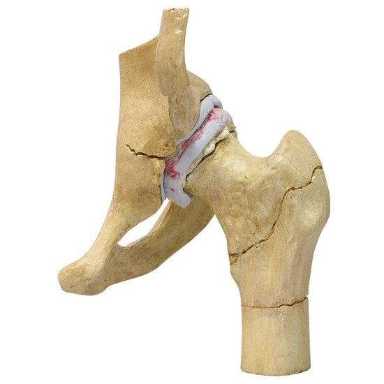 4-Stage Arthritic Hip Anatomy Model